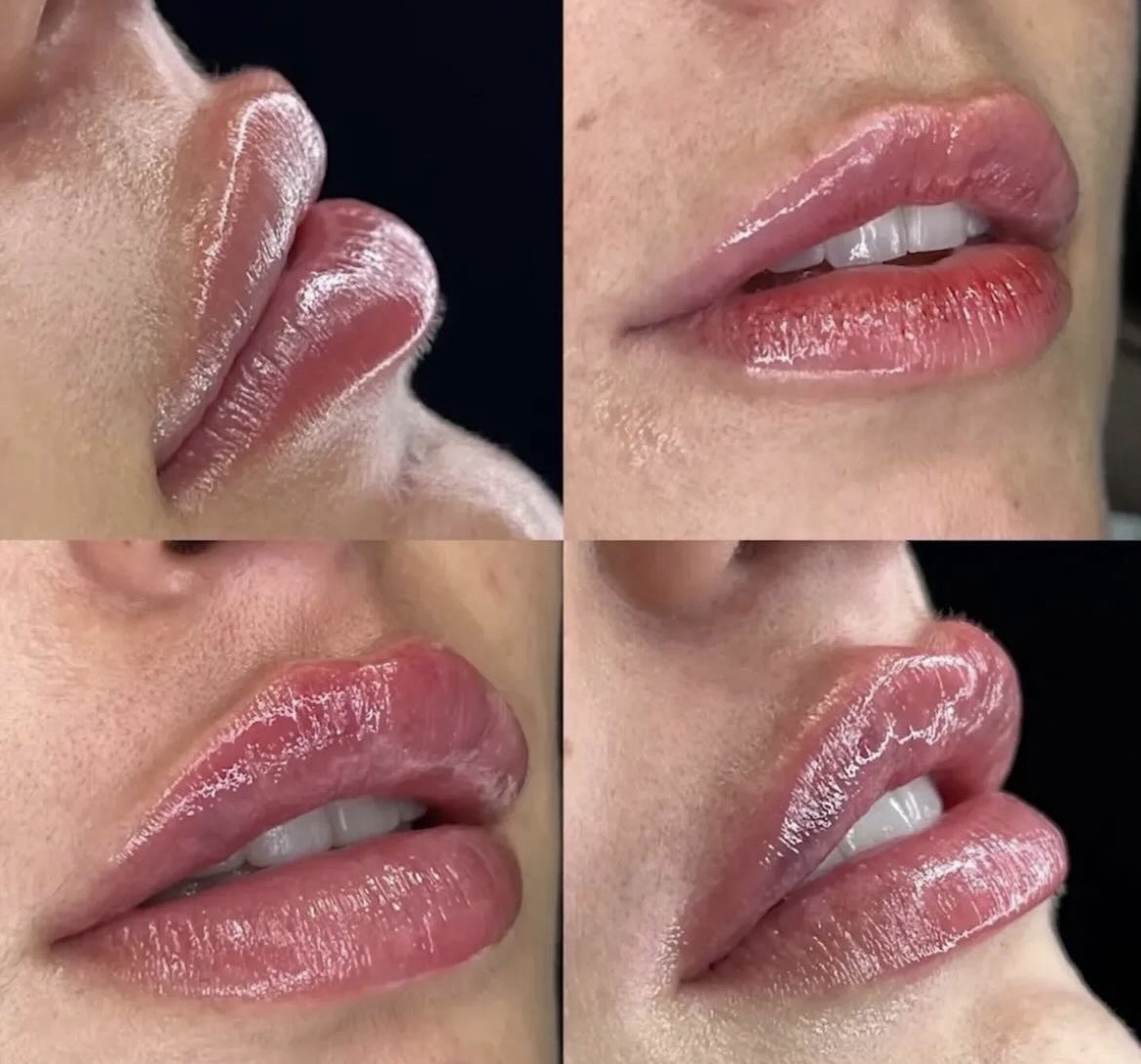 Preenchimento Labial 